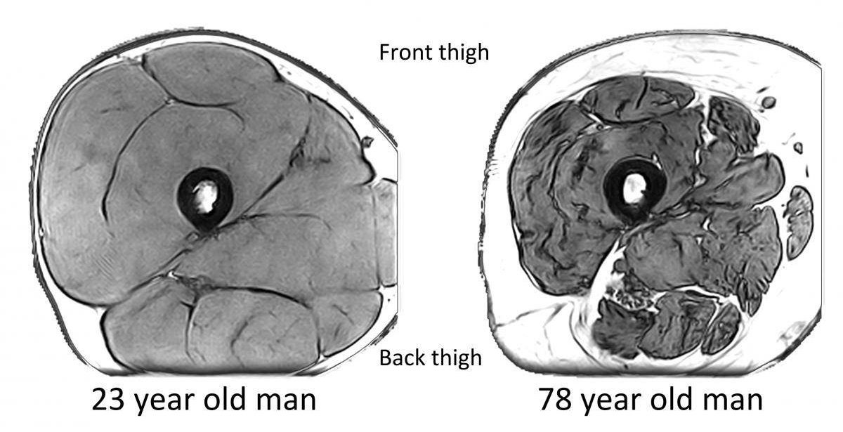 Magnetic resonance images of the mid-thigh. Femur bone is in the middle creating a black ring, muscles are shaded grey and fat is white